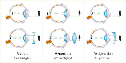 Myopie hyperopie astigmatismus